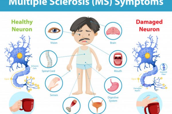 How does Multiple Sclerosis affect the Brain, Spinal cord, and Immune System?