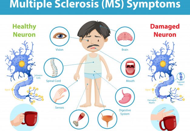 On this World Multiple Sclerosis Day, read Multiple Sclerosis symptoms, causes, and how it impacts the brain, spinal cord and the immune system.