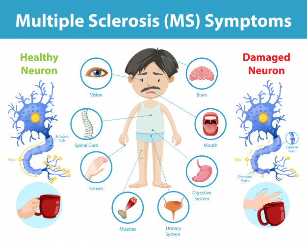 How does Multiple Sclerosis affect the Brain, Spinal cord, and Immune  System? - Gigadocs - Online Appointment with Best Doctors | Blogs