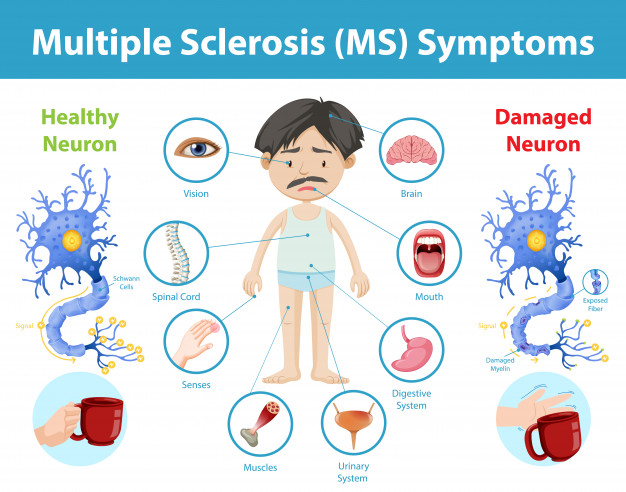 first presentation of multiple sclerosis