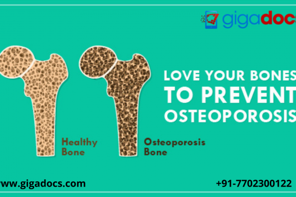 World Osteoporosis Day: Signs of Osteoporosis, Vitamins for Bones, and Bone-Strengthening Tips