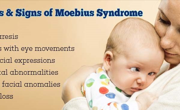 Moebius Syndrome Awareness Day: Causes, Symptoms, Diagnosis, and Treatment of the Moebius Syndrome