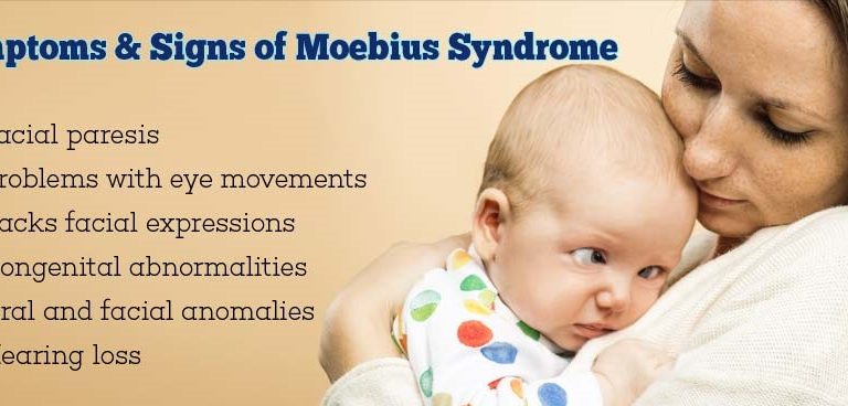 Moebius Syndrome Awareness Day: Causes, Symptoms, Diagnosis, and Treatment of the Moebius Syndrome